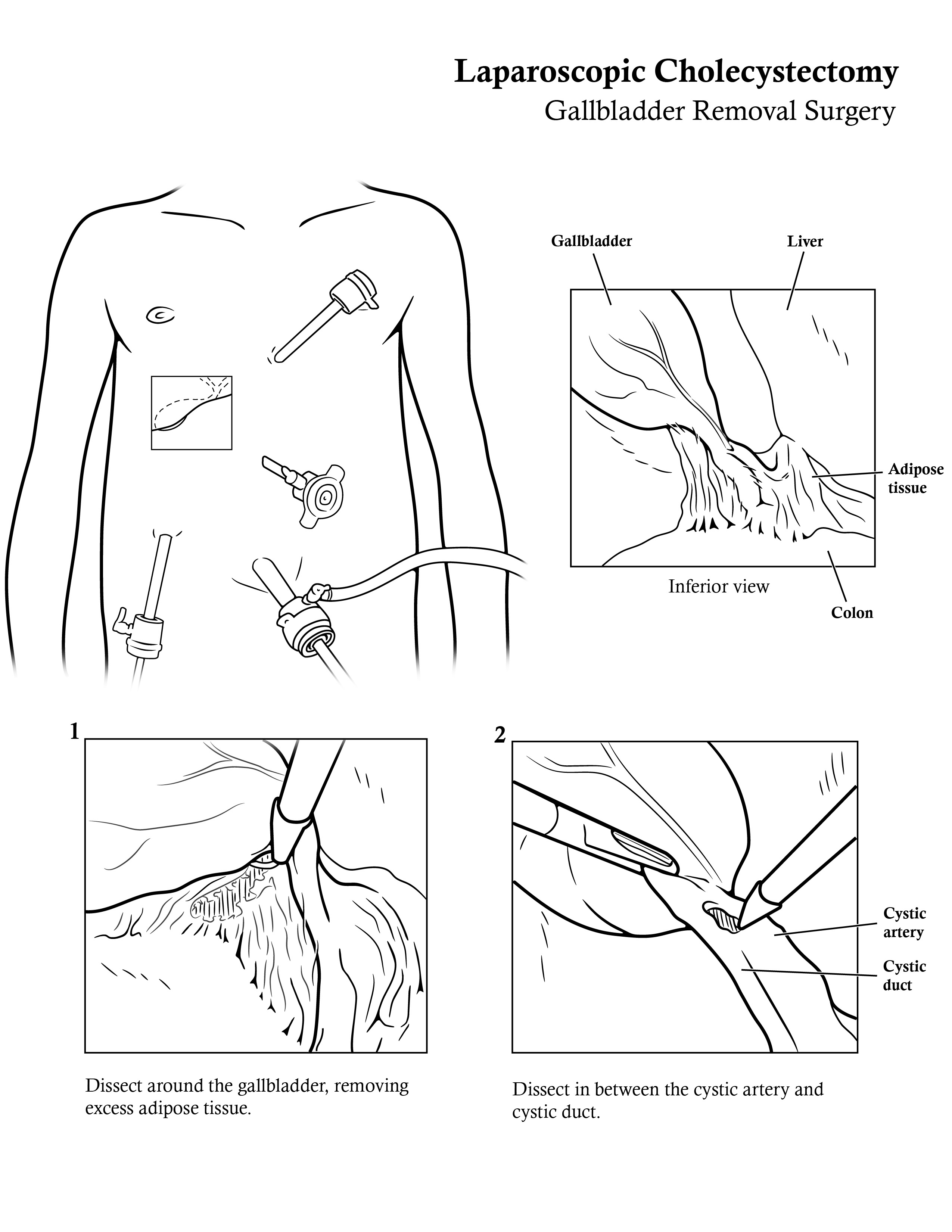Illustrated steps for laparoscopic cholecystectomy, first page