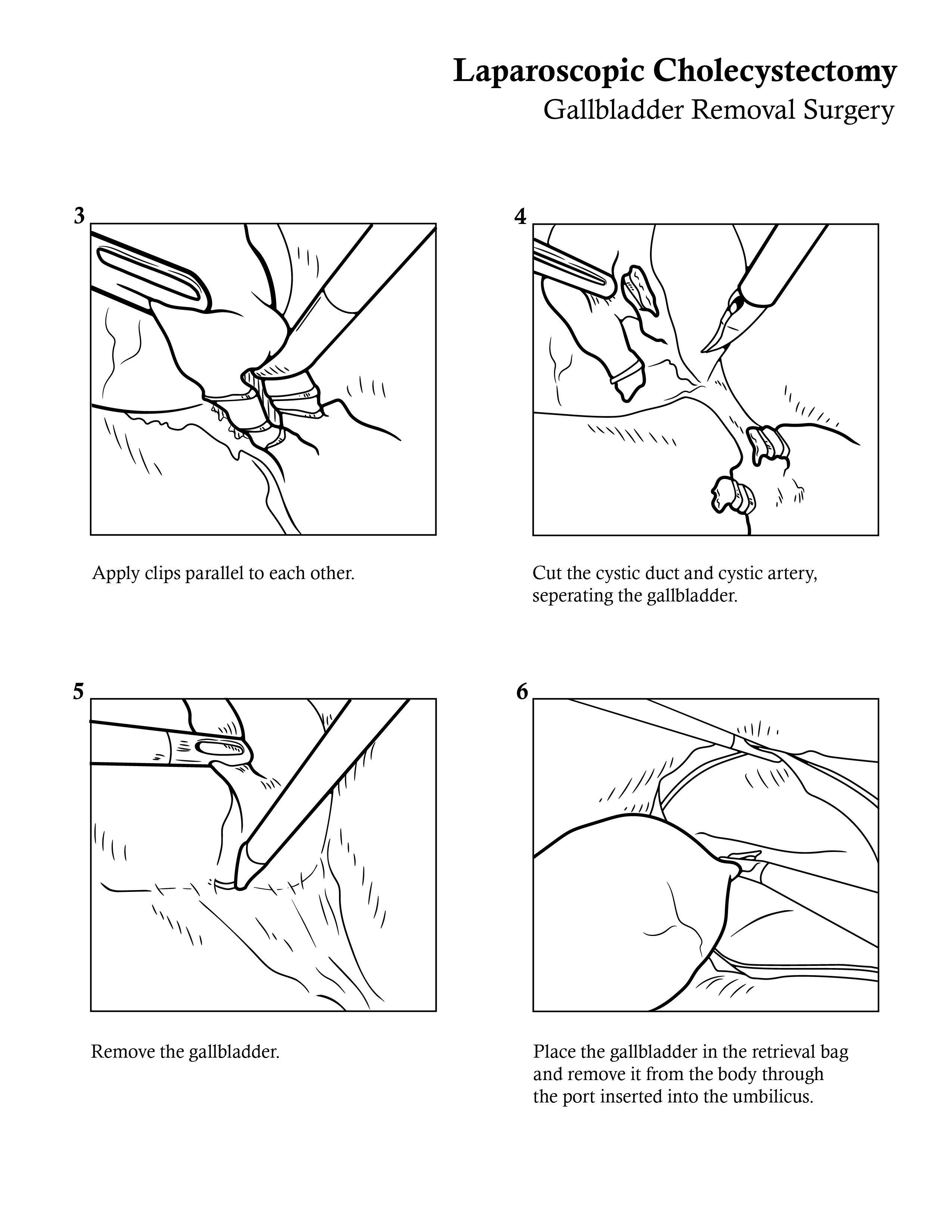 Illustrated steps for laparoscopic cholecystectomy, continued