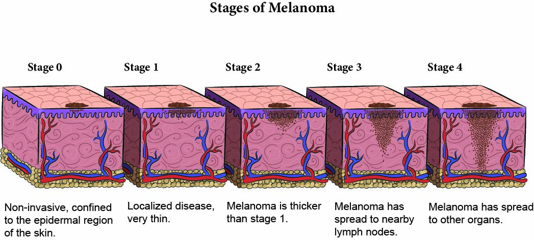 Illustrated stages of melanoma